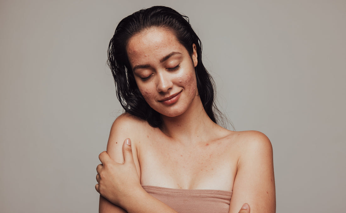 The Menstrual Cycle and Acne: Understanding the Skin’s Journey through Each Phase